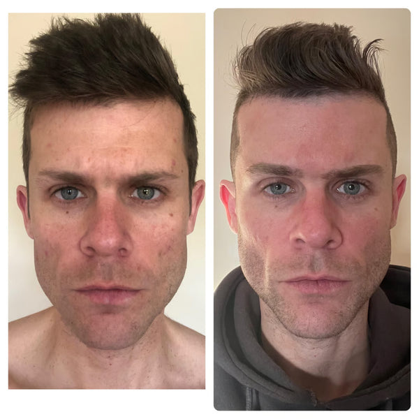 Marcos T., 37 años — 30 días